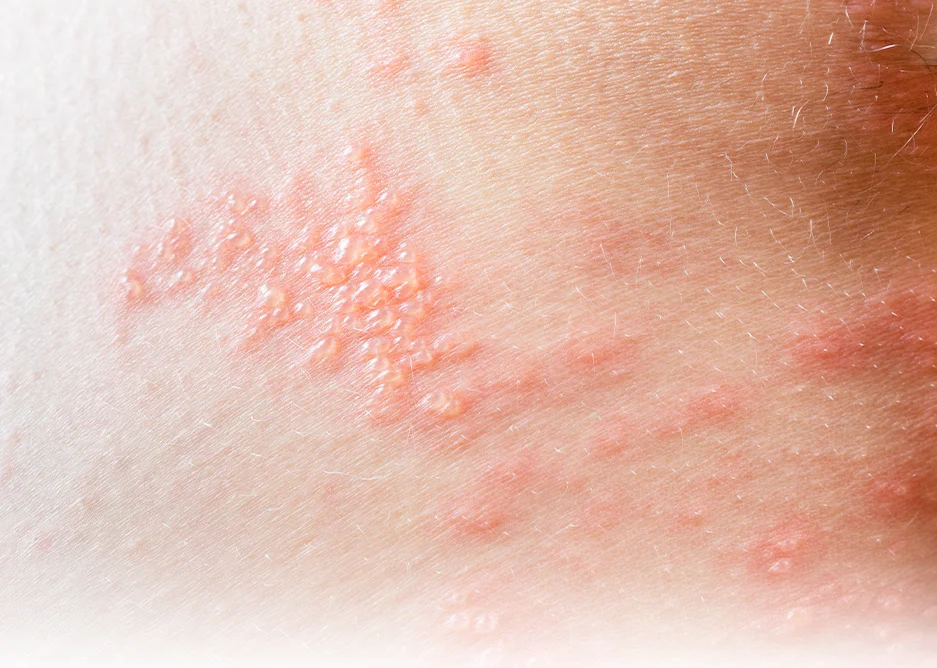 Eczema & Allergic Dermatitis Treatment by Dr. Neha Athalye, DermcareMD Kothrud Pune