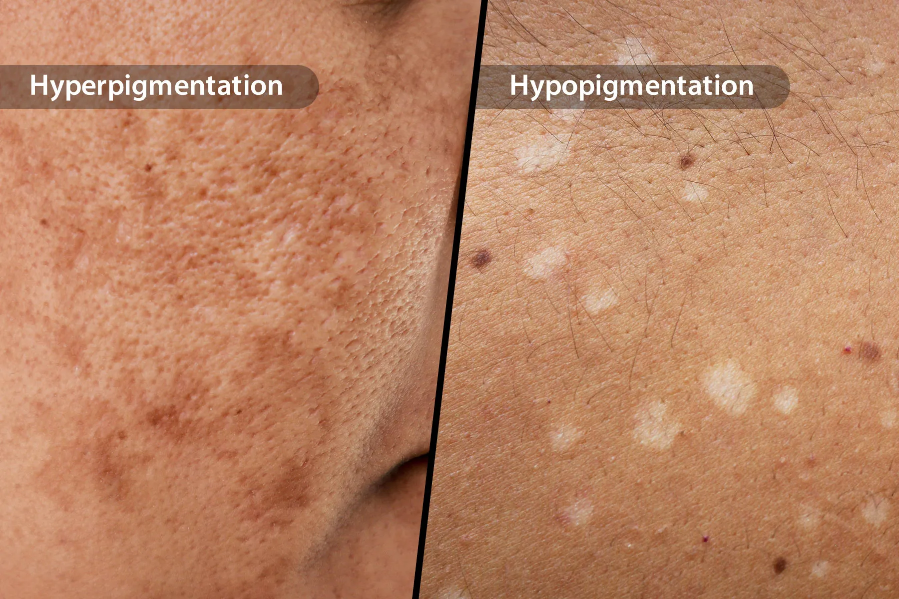Hyperpigmentation & Hypopigmentation Treatment at DermcareMD Clinic, Kothrud, Pune