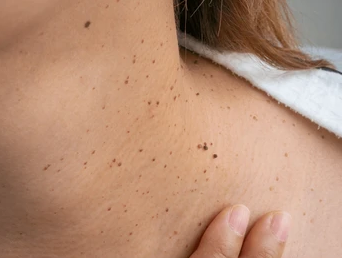 Moles, Warts & Skin Tags Removal by Dr. Neha Athalye, DermcareMD Kothrud Pune