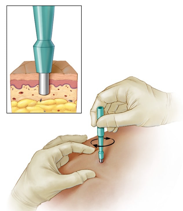 Skin Biopsy at DermcareMD Clinic, Kothrud, Pune