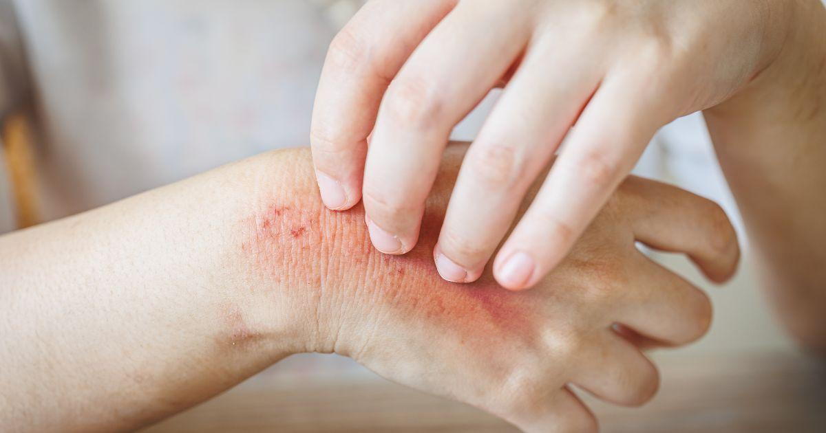 Skin Infections Treatment - Dermatologist in Kothrud, Pune